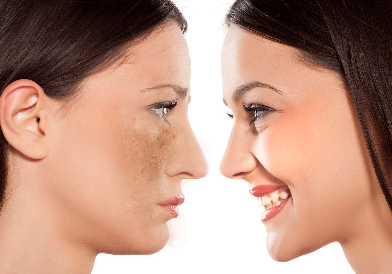 newmelan nao deixe manchas no rosto mancharem sua imagem nao deixe manchas no rosto