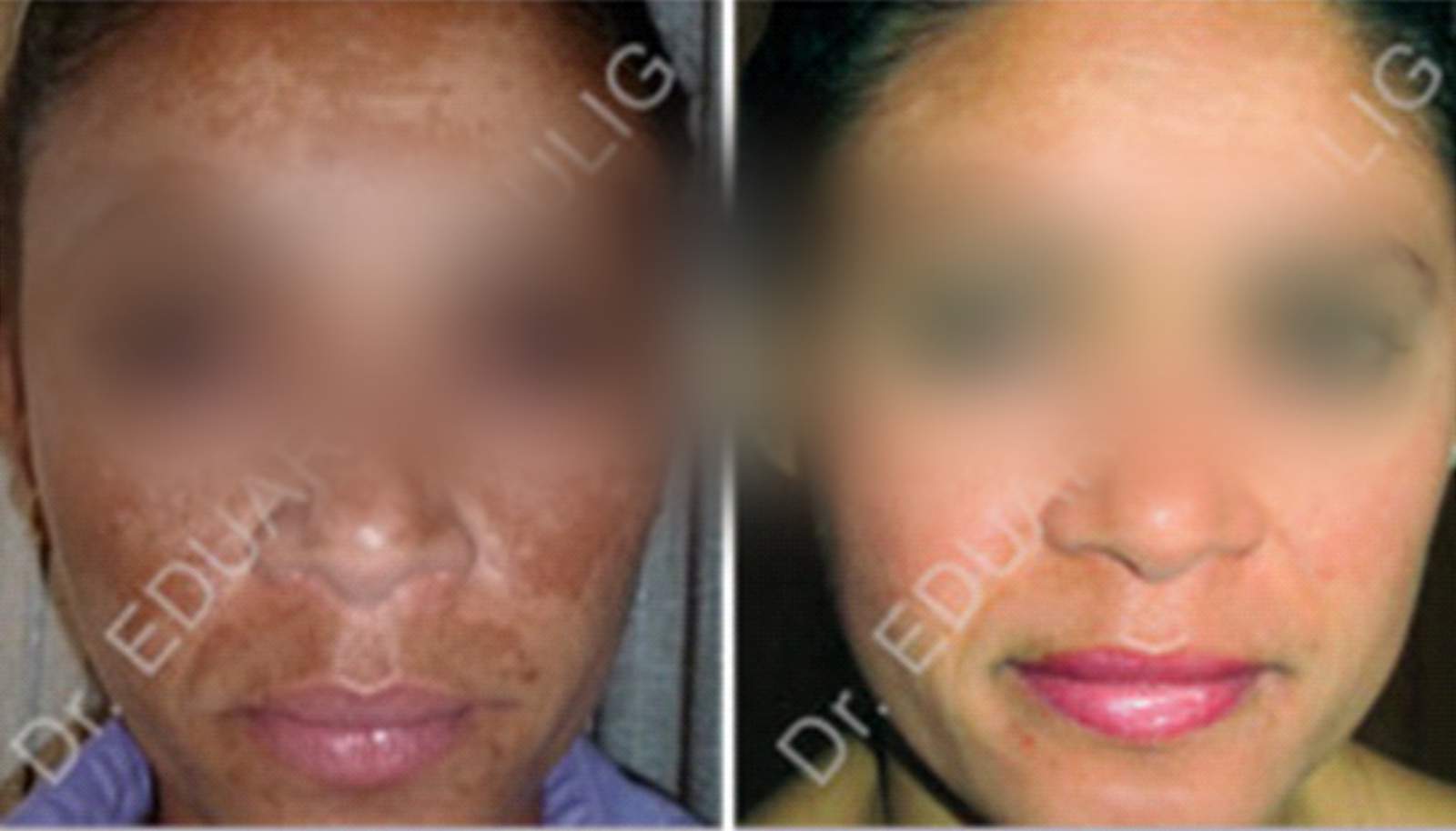 newmelan um verdadeiro e eficaz antes e depois do melasma um verdadeiro e eficaz